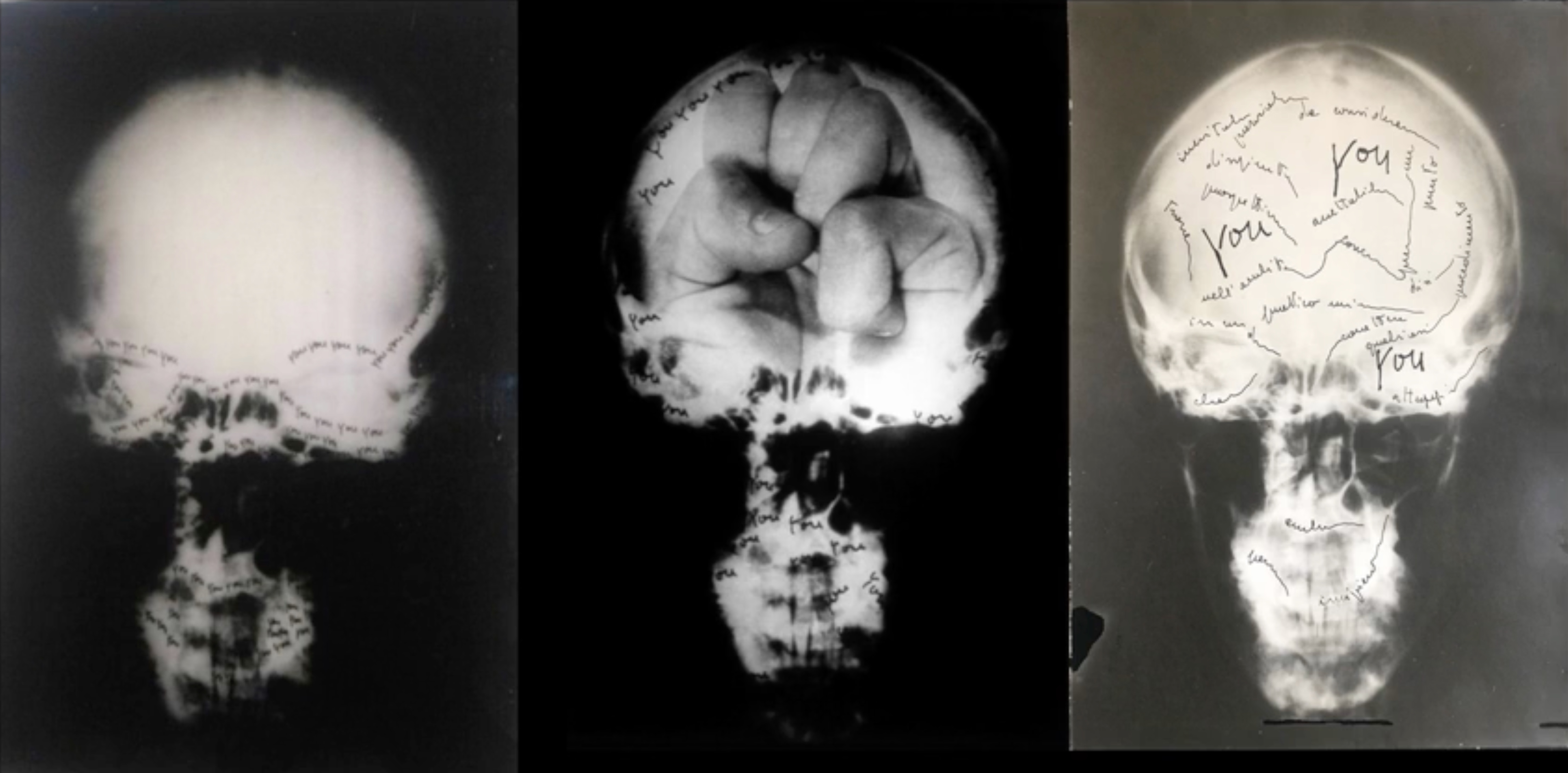 Hand in Hand mit dem Tumor